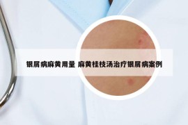 银屑病麻黄用量 麻黄桂枝汤治疗银屑病案例