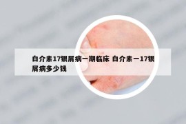 白介素17银屑病一期临床 白介素一17银屑病多少钱