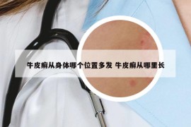 牛皮癣从身体哪个位置多发 牛皮癣从哪里长