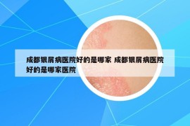 成都银屑病医院好的是哪家 成都银屑病医院好的是哪家医院