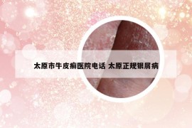 太原市牛皮癣医院电话 太原正规银屑病