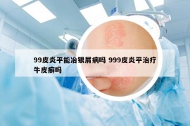 99皮炎平能冶银屑病吗 999皮炎平治疗牛皮癣吗