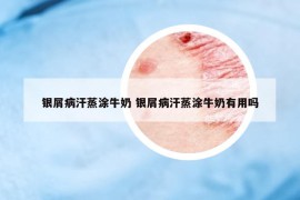 银屑病汗蒸涂牛奶 银屑病汗蒸涂牛奶有用吗