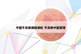 中医牛皮癣病因病机 牛皮癣中医原理