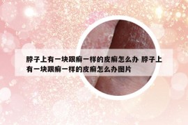 脖子上有一块跟癣一样的皮癣怎么办 脖子上有一块跟癣一样的皮癣怎么办图片