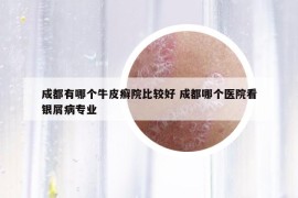 成都有哪个牛皮癣院比较好 成都哪个医院看银屑病专业