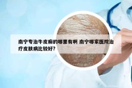 南宁专治牛皮癣的哪里有啊 南宁哪家医院治疗皮肤病比较好?