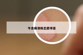 牛皮癣清除志愿项目