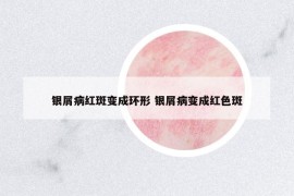 银屑病红斑变成环形 银屑病变成红色斑