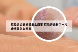 屁股旁边长癣是怎么回事 屁股旁边长了一片疙瘩是怎么回事