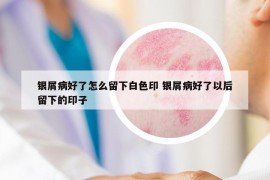 银屑病好了怎么留下白色印 银屑病好了以后留下的印子