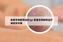 泰爱生物制剂治疗iga 泰爱生物制剂治疗狼疮肾效果