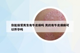 你能接受男生有牛皮癣吗 男的有牛皮病癣可以怀孕吗