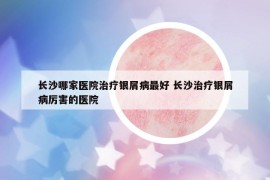 长沙哪家医院治疗银屑病最好 长沙治疗银屑病厉害的医院
