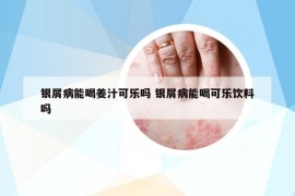 银屑病能喝姜汁可乐吗 银屑病能喝可乐饮料吗