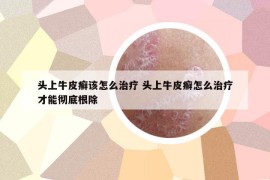 头上牛皮癣该怎么治疗 头上牛皮癣怎么治疗才能彻底根除