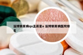 淄博银屑病qu孟晨星a 淄博银屑病医院排名