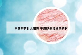 牛皮癣有什么泡澡 牛皮肤癣泡澡的药材