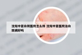 沈阳中亚白斑医院怎么样 沈阳中亚医院治白斑病好吗