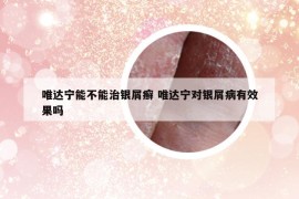 唯达宁能不能治银屑癣 唯达宁对银屑病有效果吗