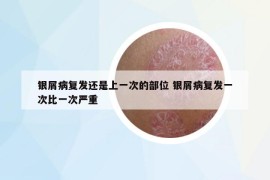 银屑病复发还是上一次的部位 银屑病复发一次比一次严重