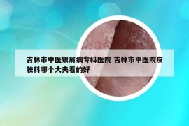 吉林市中医银屑病专科医院 吉林市中医院皮肤科哪个大夫看的好