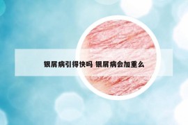 银屑病引得快吗 银屑病会加重么