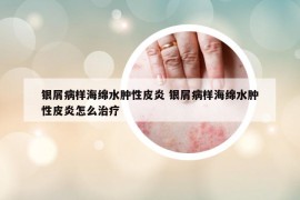 银屑病样海绵水肿性皮炎 银屑病样海绵水肿性皮炎怎么治疗