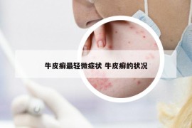 牛皮癣最轻微症状 牛皮癣的状况