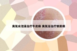 臭氧水泡澡治疗牛皮癣 臭氧浴治疗银屑病