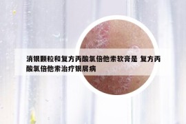 消银颗粒和复方丙酸氯倍他索软膏是 复方丙酸氯倍他索治疗银屑病