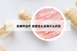 皮癣咋治疗 皮癣怎么治用什么药膏