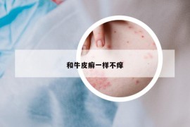 和牛皮癣一样不痒