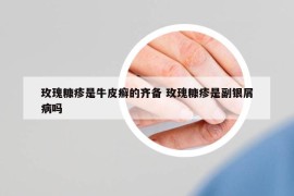 玫瑰糠疹是牛皮癣的齐备 玫瑰糠疹是副银屑病吗