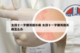 女孩十一岁腰周围长癣 女孩十一岁腰周围长癣怎么办