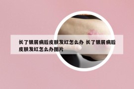 长了银屑病后皮肤发红怎么办 长了银屑病后皮肤发红怎么办图片