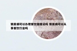 银屑病可以办理餐饮健康证吗 银屑病可以从事餐饮行业吗