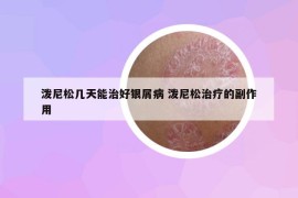 泼尼松几天能治好银屑病 泼尼松治疗的副作用