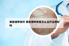 银屑病甲损坏 银屑病甲损害怎么治疗治得好吗