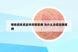 哪些因素感染导致银屑病 为什么会感染银屑病
