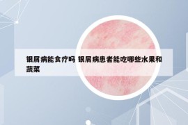 银屑病能食疗吗 银屑病患者能吃哪些水果和蔬菜
