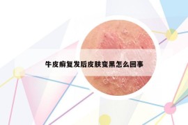 牛皮癣复发后皮肤变黑怎么回事