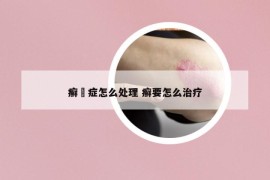 癣蔴症怎么处理 癣要怎么治疗