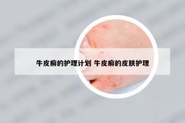 牛皮癣的护理计划 牛皮癣的皮肤护理