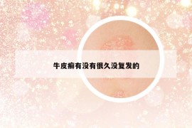 牛皮癣有没有很久没复发的