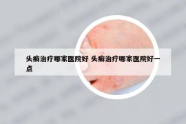 头癣治疗哪家医院好 头癣治疗哪家医院好一点