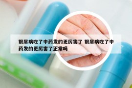 银屑病吃了中药发的更厉害了 银屑病吃了中药发的更厉害了正常吗