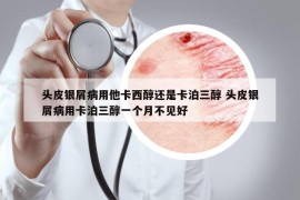 头皮银屑病用他卡西醇还是卡泊三醇 头皮银屑病用卡泊三醇一个月不见好
