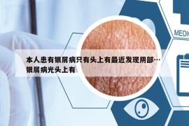 本人患有银屑病只有头上有最近发现阴部… 银屑病光头上有