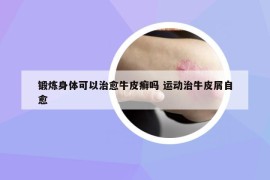 锻炼身体可以治愈牛皮癣吗 运动治牛皮屑自愈